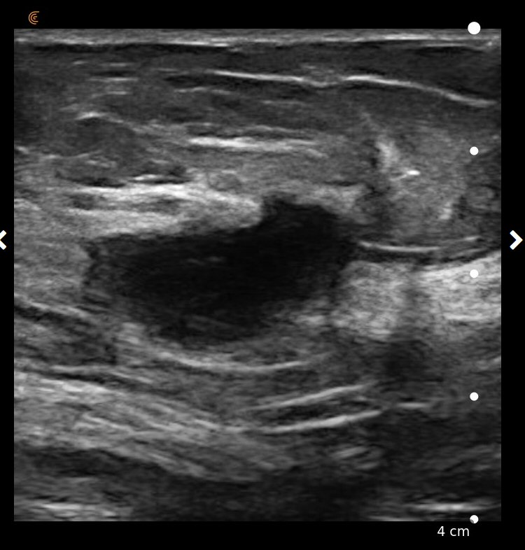 Clarius - Ultrasonido mamario de alta resolución
